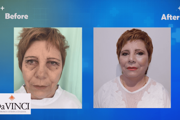 Lifting i fytyres - Operacioni Lifting i fytyres - tërheqja e lëkurës së fytyrës - Doktor Plastik